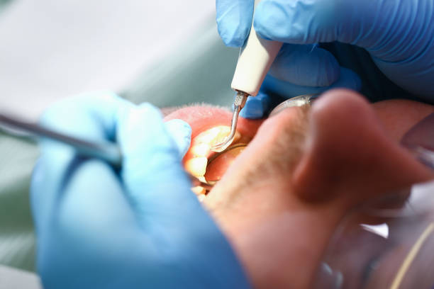 Best Emergency Treatment for Dental Infections or Abscesses in Harrisonburg, VA